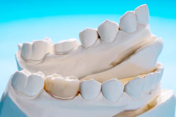 How Long Will A Dental Crown Last?
