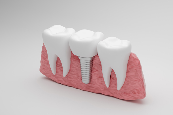 What To Do If A Dental Implant Crown Breaks