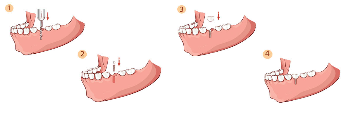 Los Angeles Dental Implant Restoration