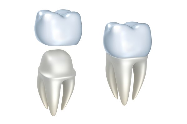 dental implants Los Angeles, CA