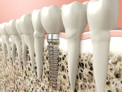 Dental Implants: Why Your Jawbone Needs Them