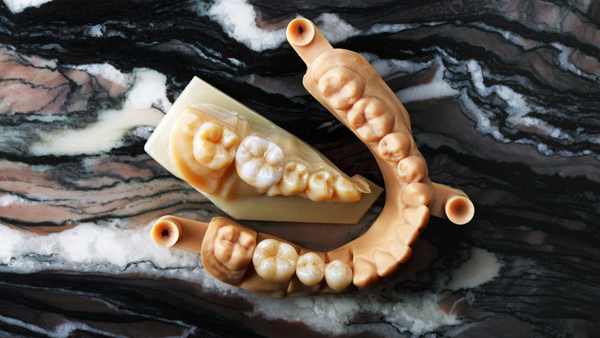 Benefits Of Implant Supported Dentures