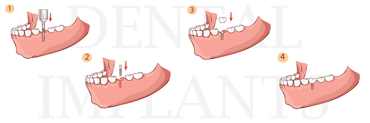 Los Angeles The Difference Between Dental Implants and Mini Dental Implants