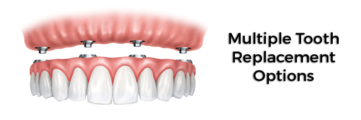 Los Angeles Multiple Teeth Replacement Options