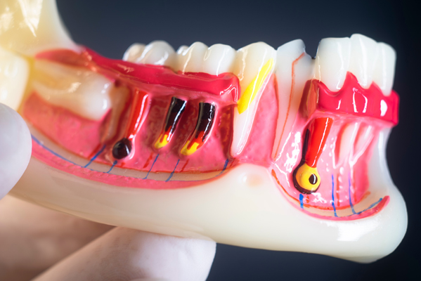 Possible Complications Of Root Canals And How To Avoid Them